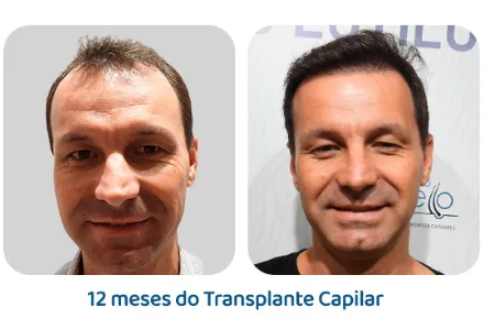 Antes e depois 10