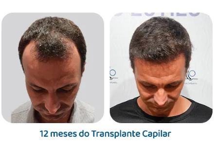 Antes e depois 11