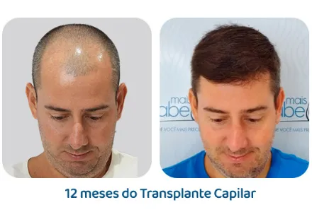 Antes e depois 12