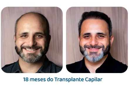 Antes e depois 7